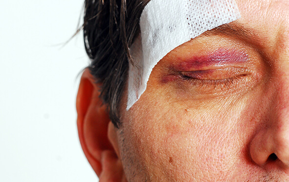 Körperverletzung, ein Opfer hat eine deutliche Verletzung im Gesicht und einen Verband am Kopf